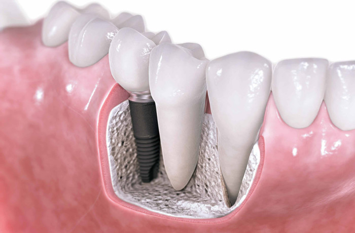 Качественная имплантация зубов с точным восстановлением зубного ряда